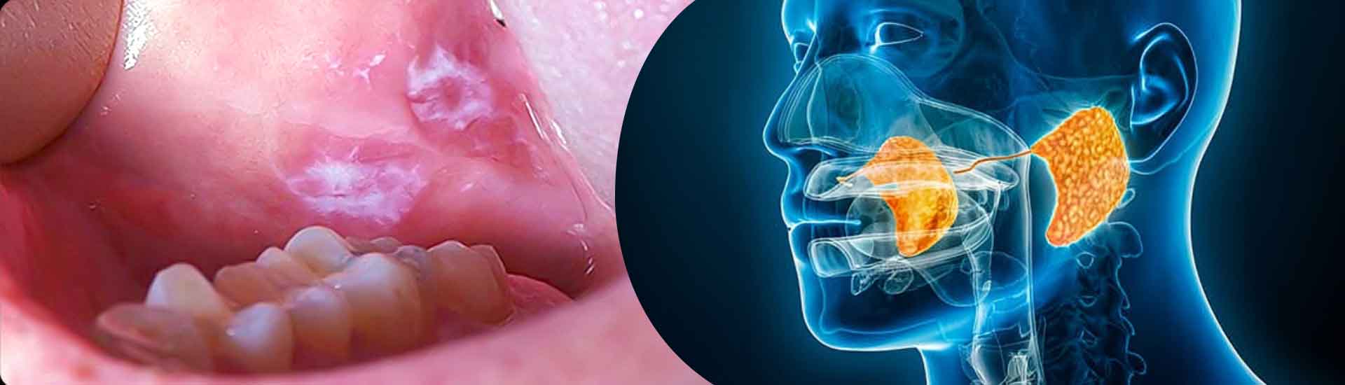 How Timely Treatment Can Change the Outcome of Oral Cancer