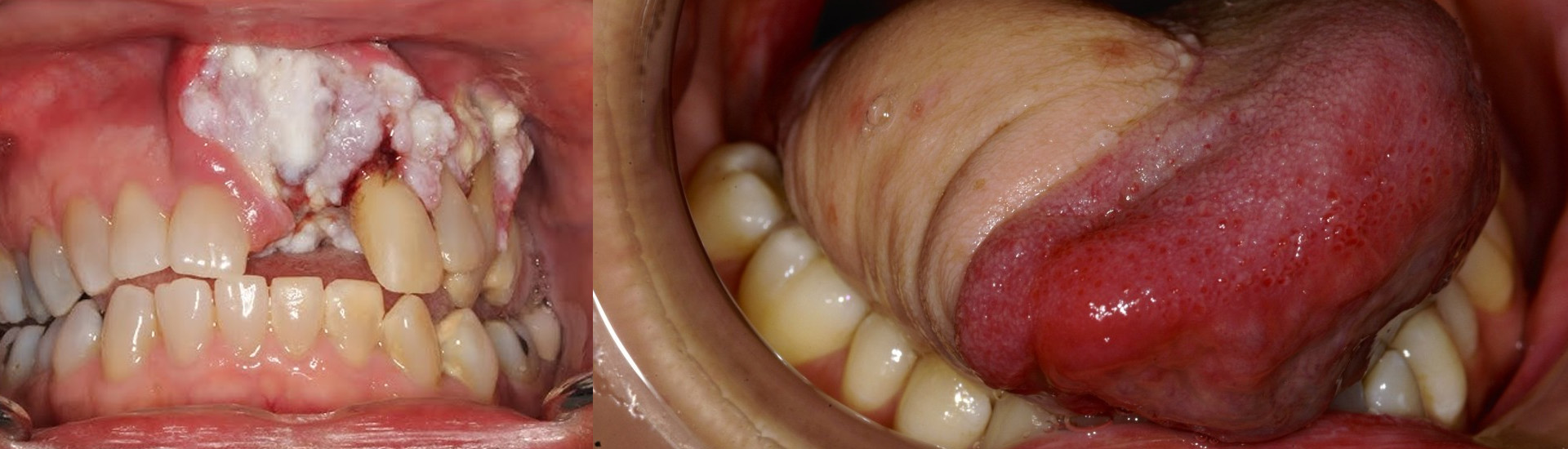 How Quitting Smoking Reduce Your Oral Cancer Risk