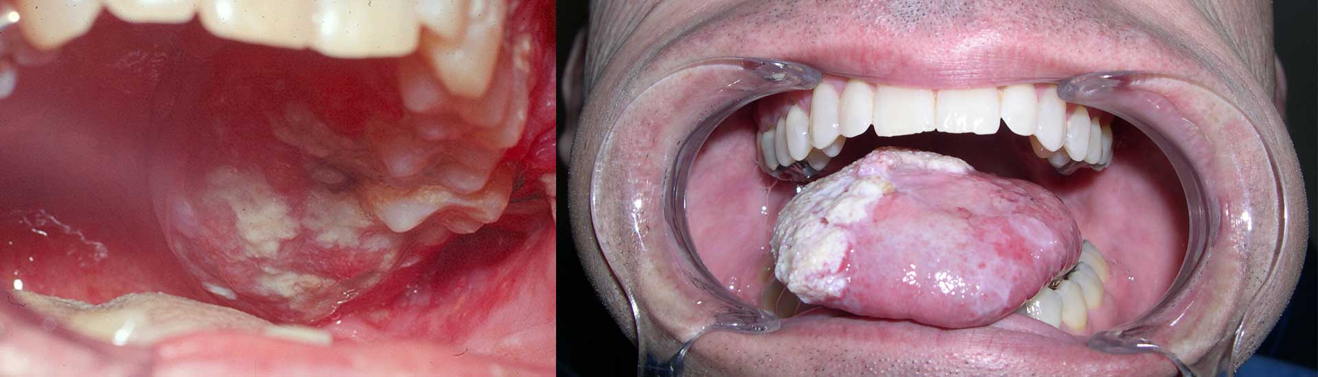 Mouth Cancer Explained: A Guide to Detection and Treatment