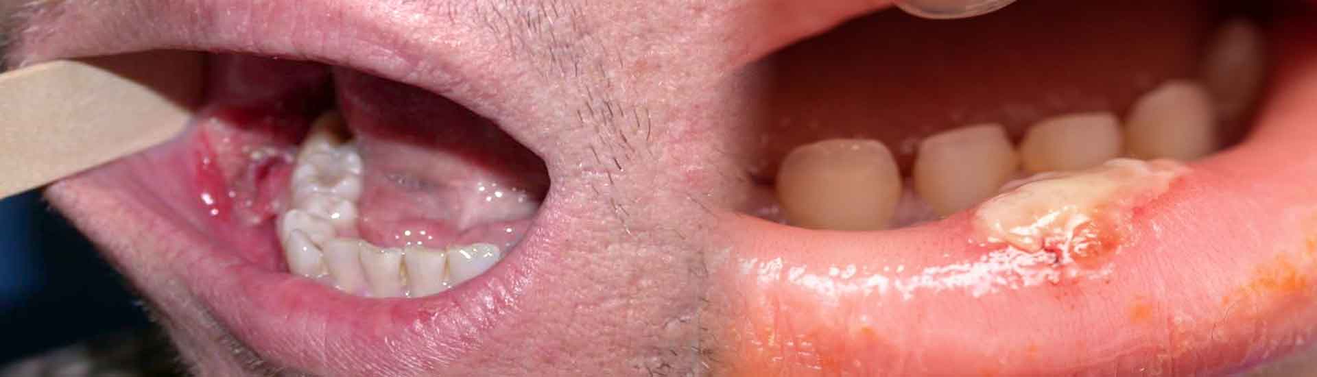 Warning Signs of Mouth Cancer in Men and Women