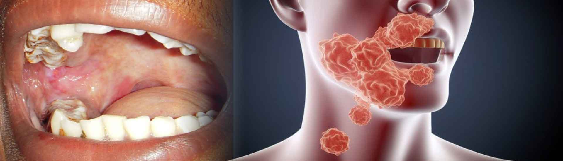 Oral Submucous Fibrosis OSMF Symptoms, Treatment and Oral Cancer Risk