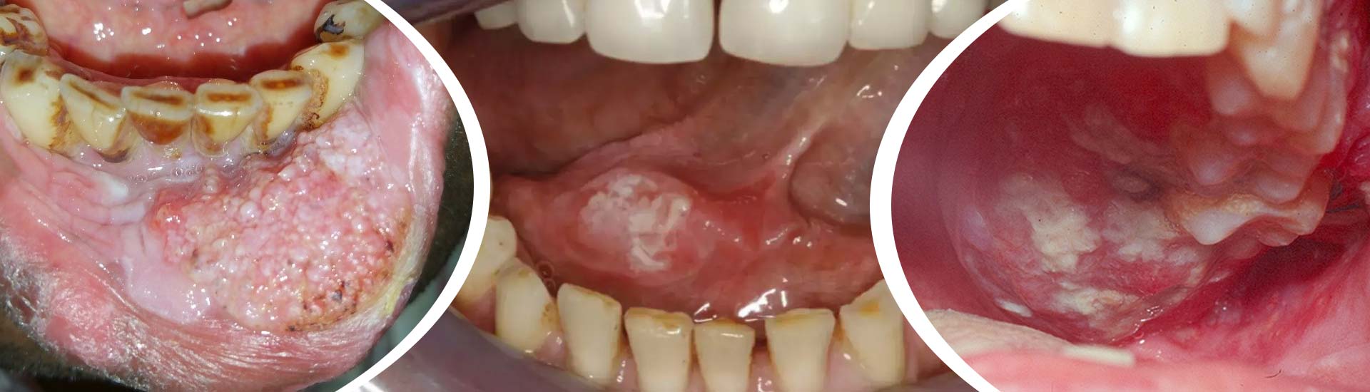 Key Difference between Oral Cancer and Other Mouth Diseases