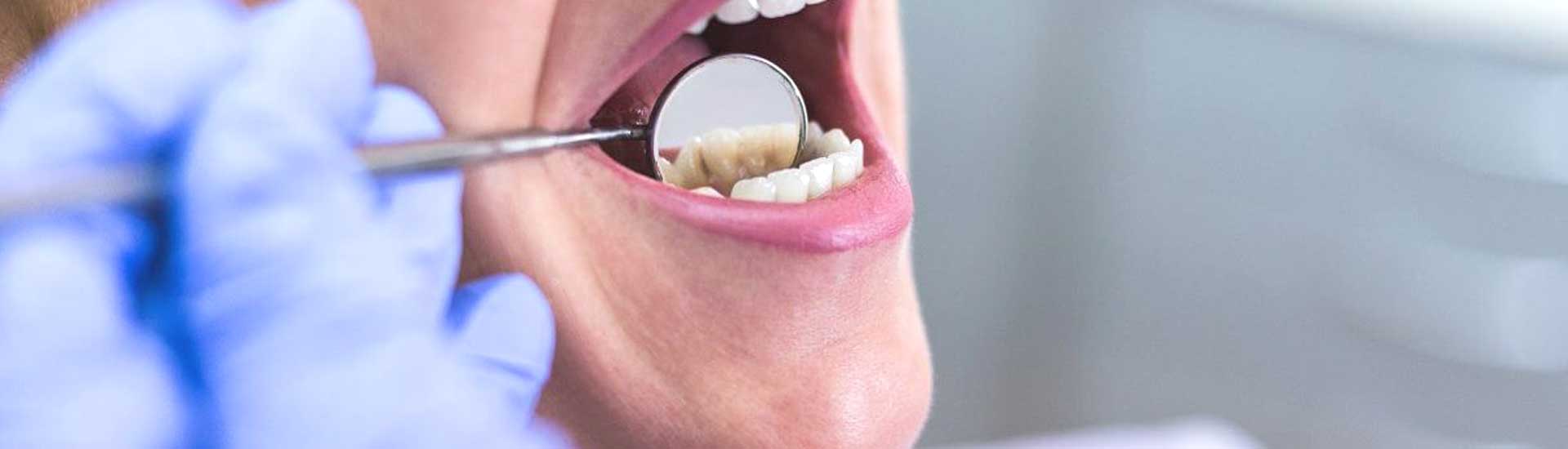 Early Signs of Oral Cancer You Should Never Ignore