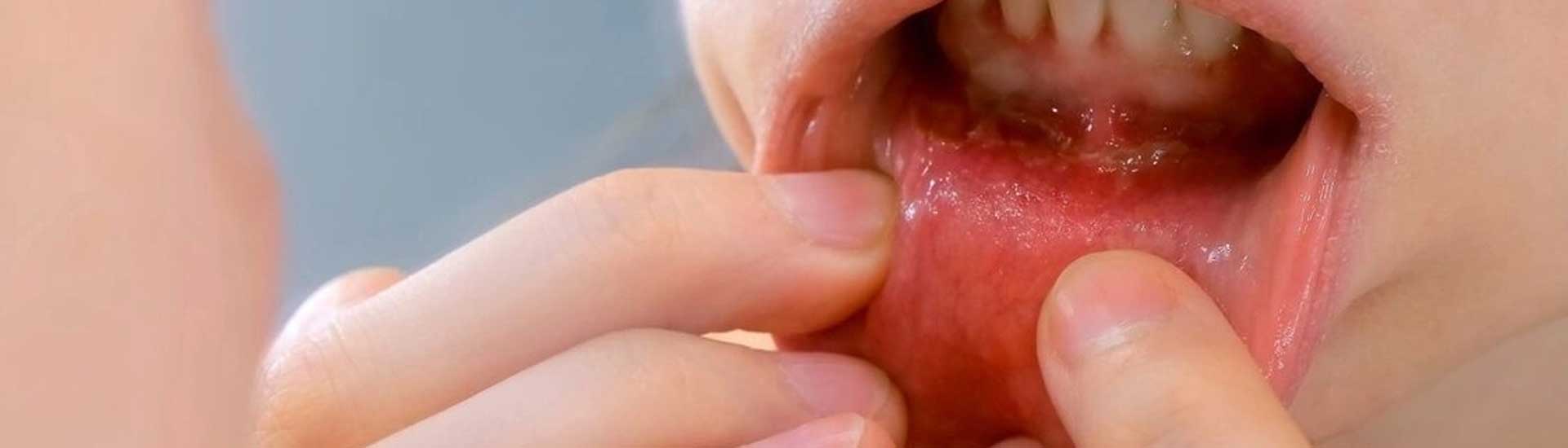 Side Effects Oral Cancer Treatment