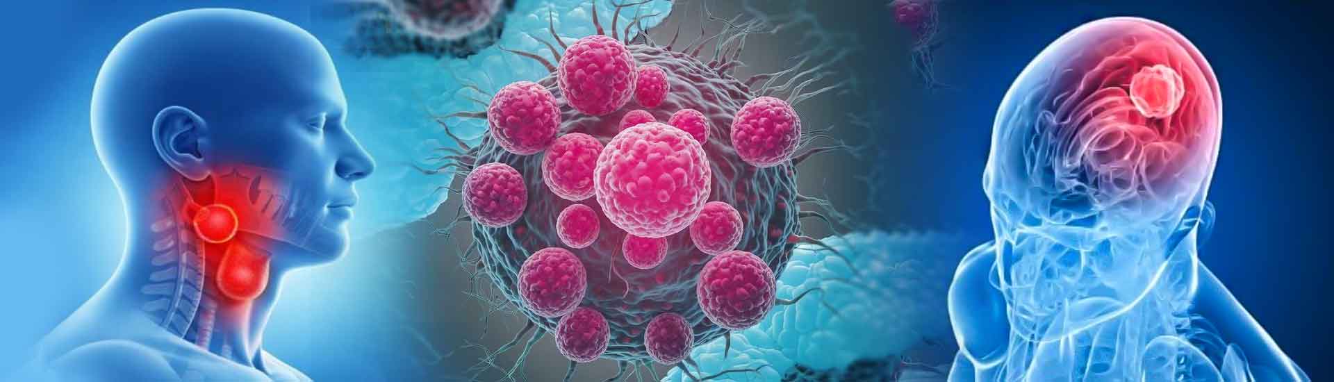 Early Warning Signs Of Head And Neck Cancer